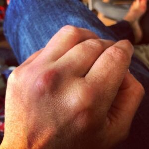 verkleurde huid CRPS